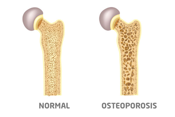 Hueso normal comparado con hueso con osteoporosis