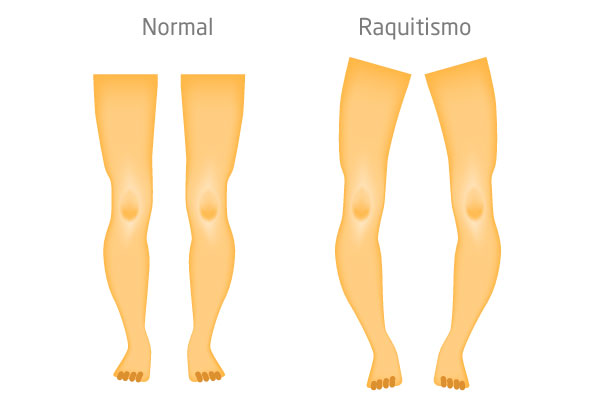 Raquitismo